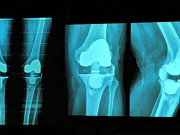 Knieprothese im Röntgenbild