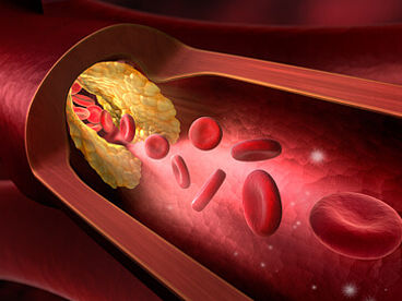 Schematische Darstellung eines Blutgefäßes, welches durch Ablagerungen an der inneren Wandschicht verengt wird. Die Blutplättchen können nur erschwert die Engstelle passieren.