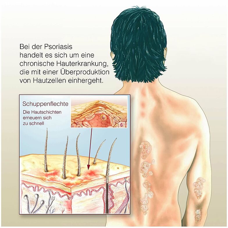 Schaubild Schuppenflechte mit Erklärung der Ursache - zu schnelle Erneuerung der Haut.