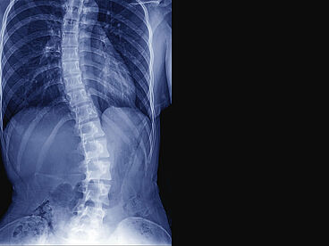 Röntgenaufnahme des Rückens bei einem Jugendlichen mit Skoliose.
