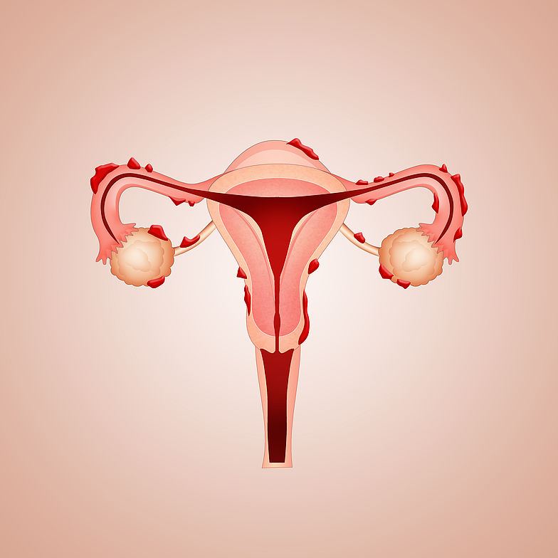 Schematische Abbildung einer Gebärmutter mit typischen Stellen der Endometriose.