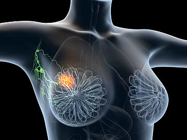 Schematische Darstellung des weiblichen Oberkörpers. Brustgewebe und ein Krebsbefall an der linken Brust ist zu erkennen.