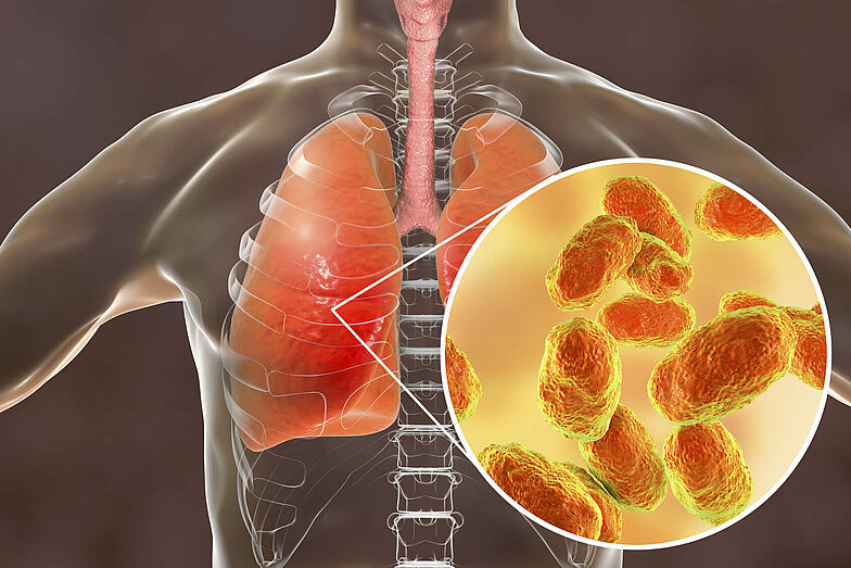 Schematischer und vergrößerter Ausschnitt einer Lunge. Eine durch Bakterien hervorgerufene Entzündung ist zu erkennen.