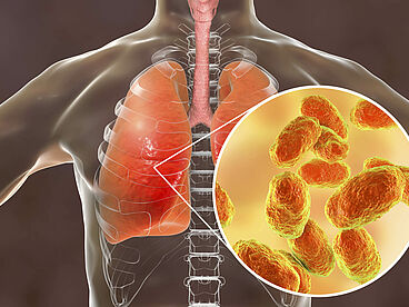 Schematischer und vergrößerter Ausschnitt einer Lunge. Eine durch Bakterien hervorgerufene Entzündung ist zu erkennen.
