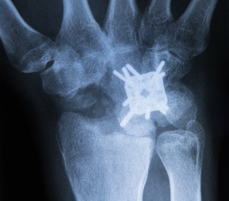 Röntgenaufnahme einer Gelenkversteifungsoperation an der Hand.