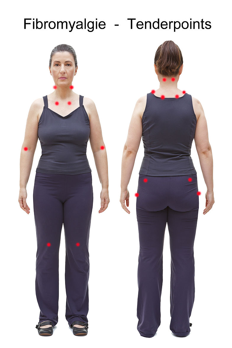 Am Körper einer Frau sind die 18 Tenderpoints schematisch dargestellt. Zur Diagnose übt der Arzt mit dem Daumen Druck auf die Triggerpunkte aus. Wenn bei 11 oder mehr Tenderpoints Schmerzen verspürt werden, kann von einer Fibromyalgie ausgegangen werden.