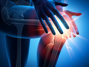Eine Fraktur der Kniescheibe führt zu Schmerzen und Schwellungen. 