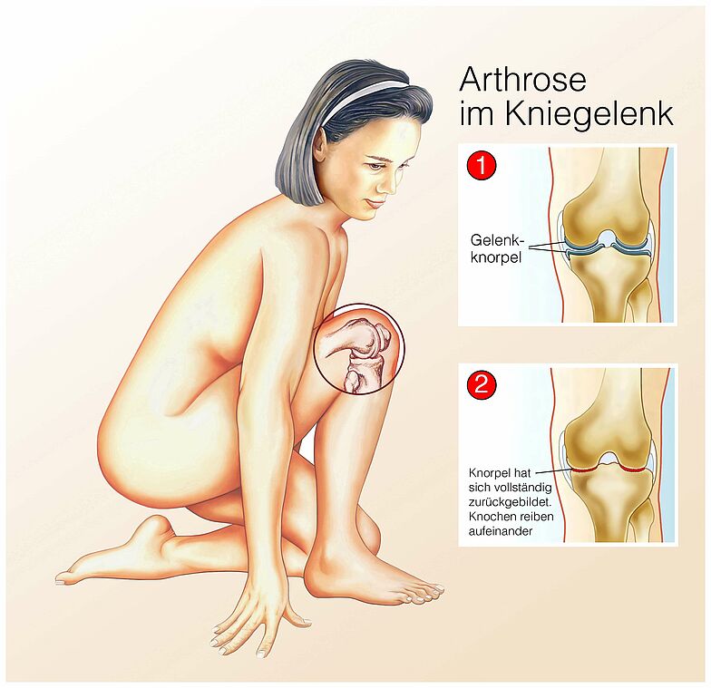Schaubild zu Kniearthrose im Kniegelenk mit anatomischer Abbildungen der Abnutzung.