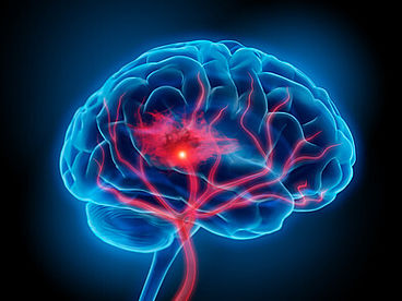 Darstellung einer Blutung im menschlichen Gehirn