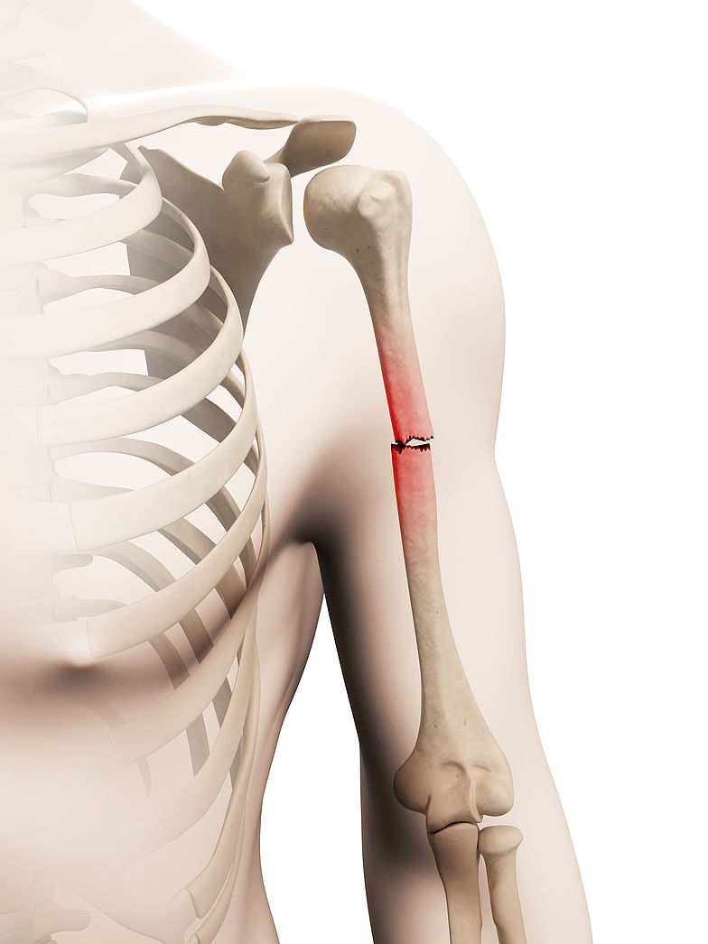 Darstellung des Oberarmbruches anhand eines Anatomiebildes mit Fokus den verletzten Arm