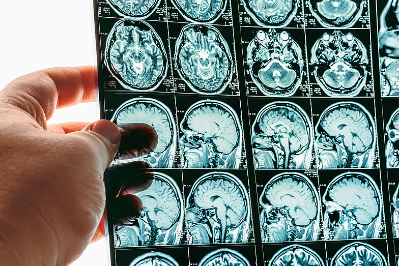 Zur Diagnose eines Schädel-Hirn-Traumas werden bildgebende Verfahren wie Magnetresonanztomographie und Computertomographie genutzt. Zu sehen hier sind MRT-Aufnahmen vom Kopf.