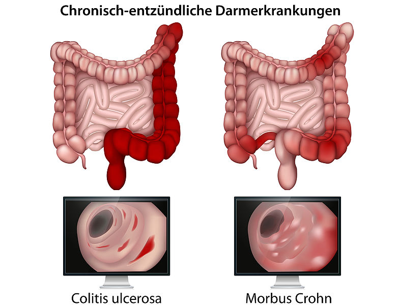 Schematische Darstellung des Unterschieds zwischen Colitis ulcerosa und Morbus Chron.