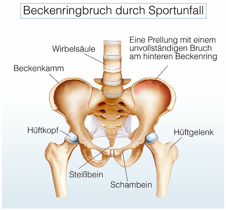 Anatomische Darstellung einer Prellung mit einem unvollständigen Bruch am hinteren Beckenring. Zu sehen sind auch die Bestandteile Steißbein, Schambein, Hüftgelenk, Hüftkopf, Beckenkamm sowie Teile der Wirbelsäule.
