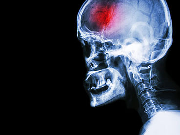 Seitliche Röntgenaufnahme eines menschlichen Kopfes. Der Stirnbereich ist farblich hervorgeheben, dort ist ein Schlaganfall erkennbar.