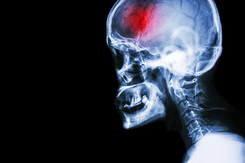 Röntgenbild eines menschlichen Schädels. Der vordere Bereich des Kopfes ist rot eingefärbt, dort kann sich ein Hirntumor befinden. 
