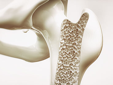 Anatomisches Modell Osteoporose Femur