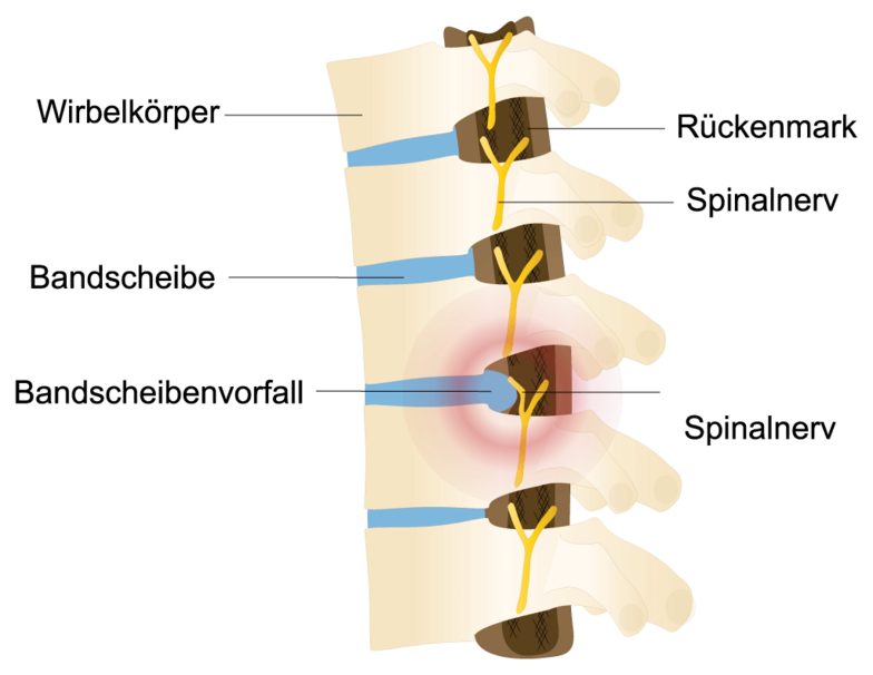 Schematische Darstellung Bandscheibenvorfall: Wirbelkörper, Rückenmark, Spinalnerv, Bandscheibe und Bandscheibenvorfall