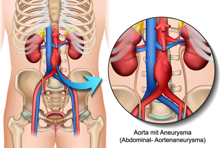 Schematische und anatomische Darstellung eines Aortenaneurysma.