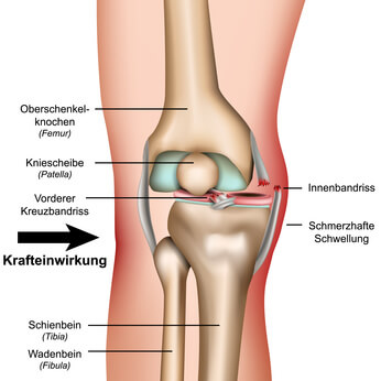 Anatomische Darstellung eines Kniegelenks mit einem vorderen und hinteren Kreuzbandriss.