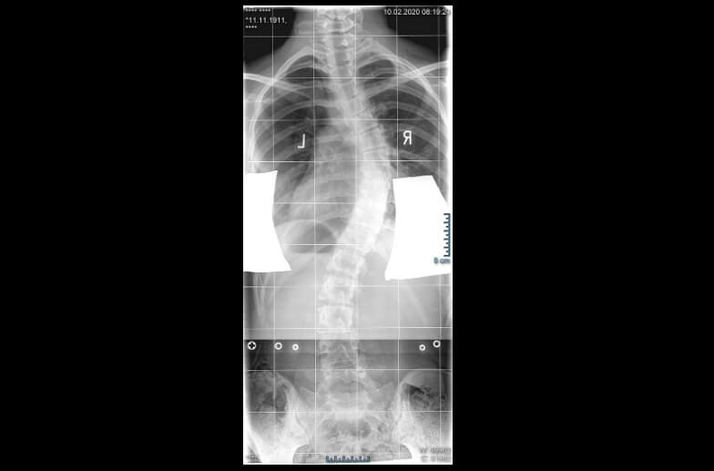 Röntgenbild einer Skoliose an der Wirbelsäule.